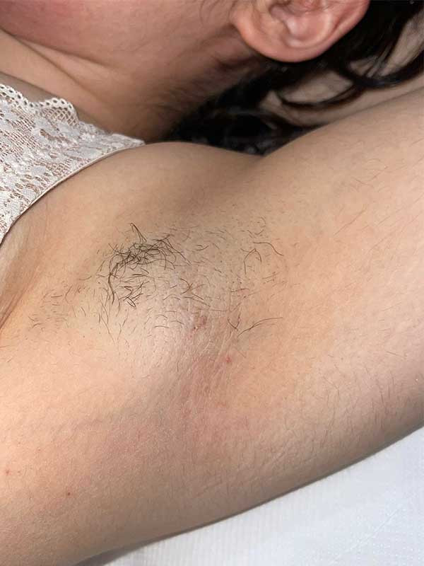 Estetica Saphir - Risultato dalla Prima seduta (dopo un mese)