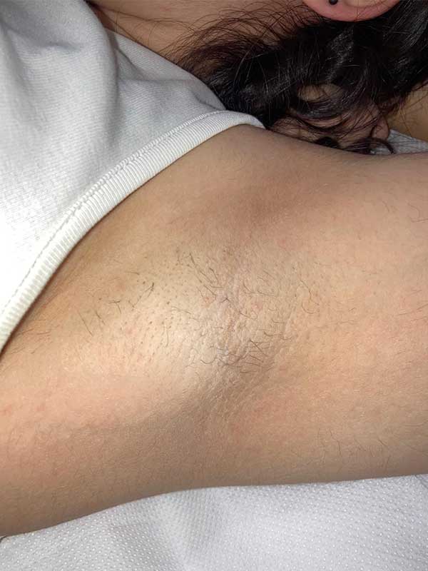 Estetica Saphir - Seconda seduta - Risultato dopo 2 mesi dalla prima seduta